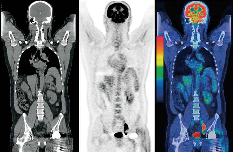 PET CT com FDG-18F - Medicina Nuclear | Dr. Renato Barra