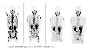 Terapia com Lutécio-177-PSMA